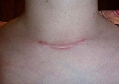 Cicatrice chéloïde après une chirurgie classique